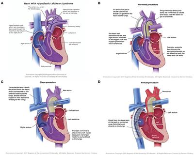 Review on Mechanical Support and Cell-Based Therapies for the Prevention and Recovery of the Failed Fontan-Kreutzer Circulation